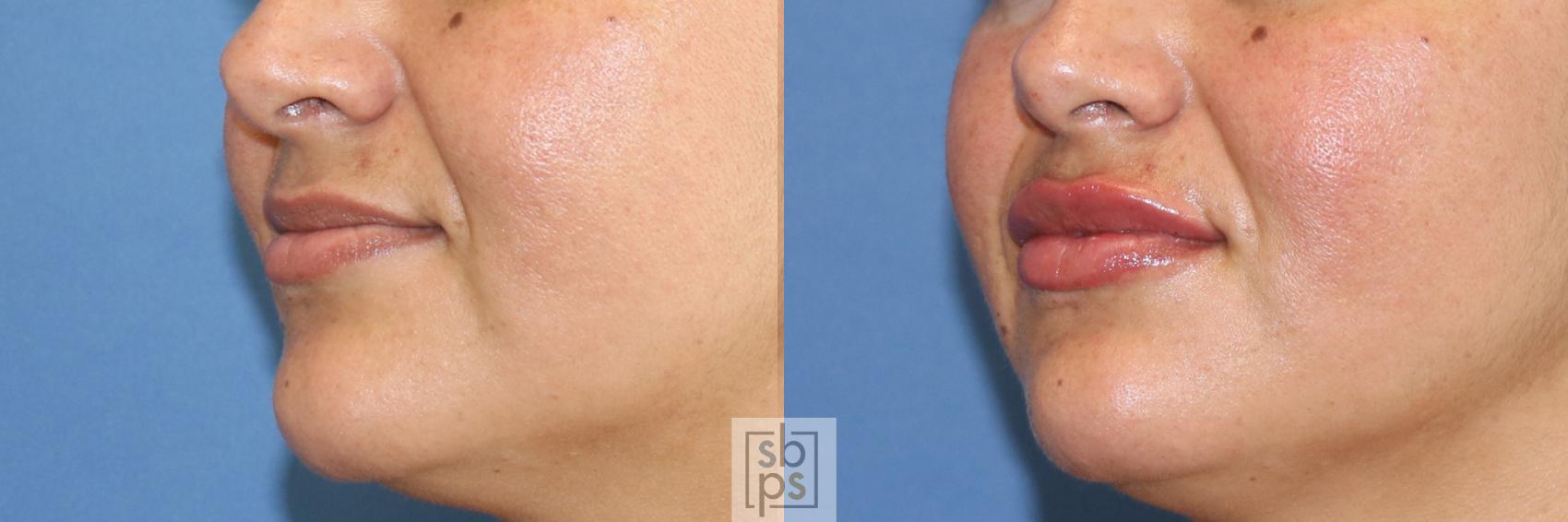 Before & After Dermal Fillers Case 392 Left Oblique View in Torrance & Los Angeles, CA, CA