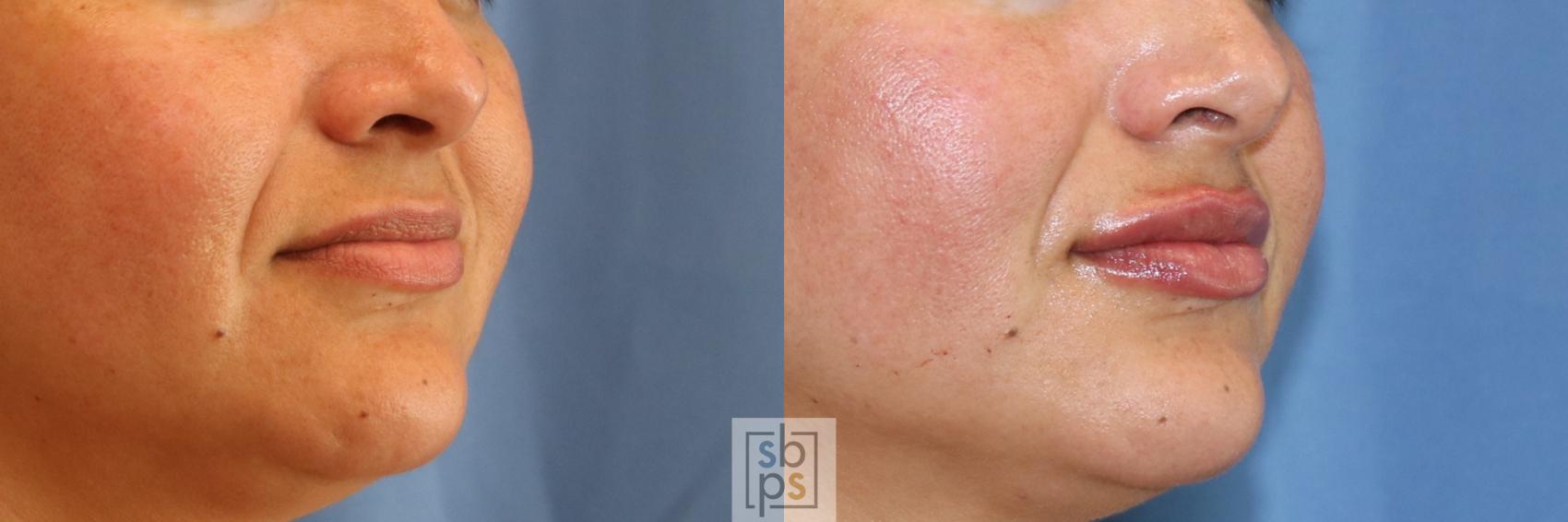 Before & After Dermal Fillers Case 392 Right Oblique View in Torrance & Los Angeles, CA, CA