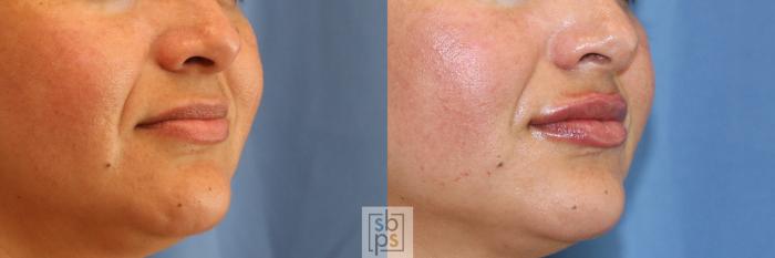Before & After Dermal Fillers Case 392 Right Oblique View in Torrance, CA