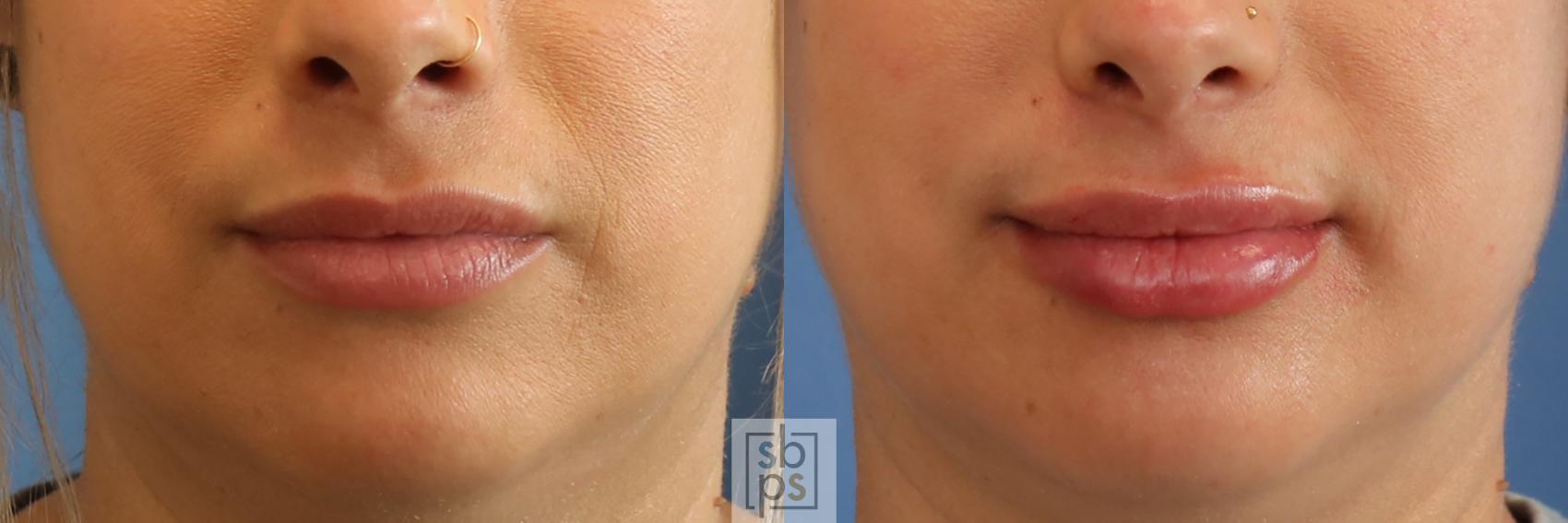 Before & After Dermal Fillers Case 397 Front View in Torrance, CA
