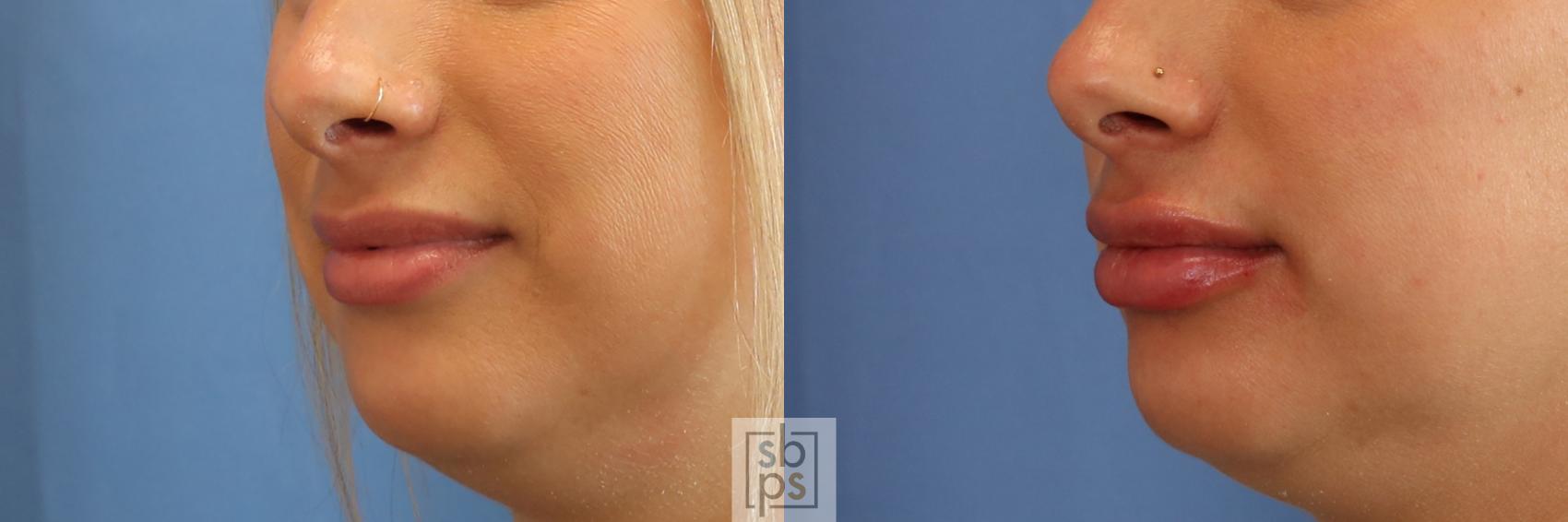 Before & After Dermal Fillers Case 397 Left Oblique View in Torrance & Los Angeles, CA, CA