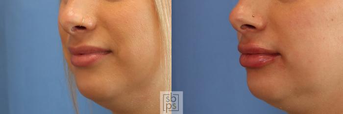 Before & After Dermal Fillers Case 397 Left Oblique View in Torrance, CA