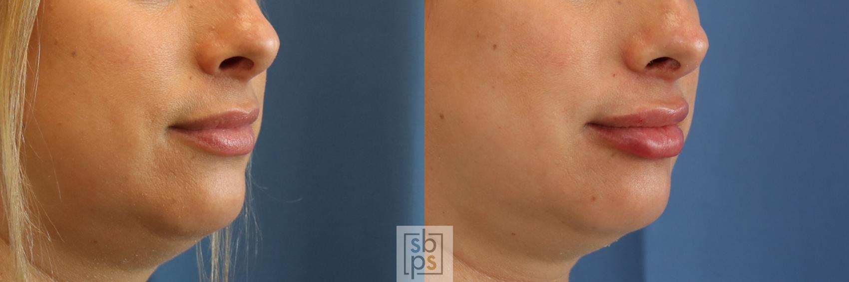 Before & After Dermal Fillers Case 397 Right Oblique View in Torrance & Los Angeles, CA, CA
