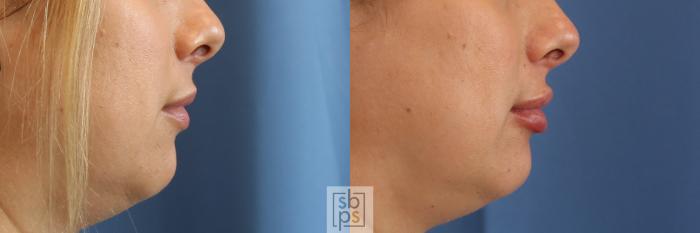 Before & After Dermal Fillers Case 397 Right Side View in Torrance, CA