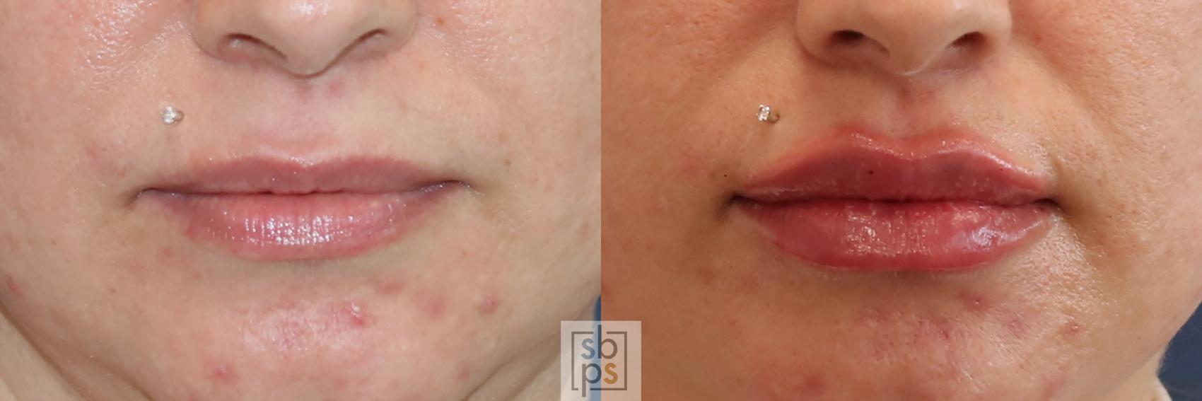 Before & After Dermal Fillers Case 415 Front View in Torrance, CA
