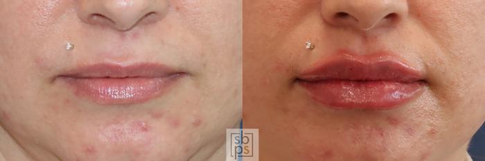 Before & After Dermal Fillers Case 415 Front View in Torrance, CA