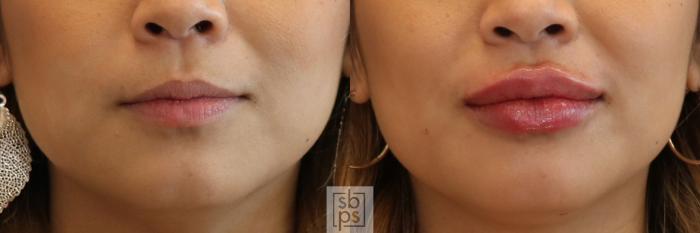 Before & After Dermal Fillers Case 419 Front View in Torrance, CA