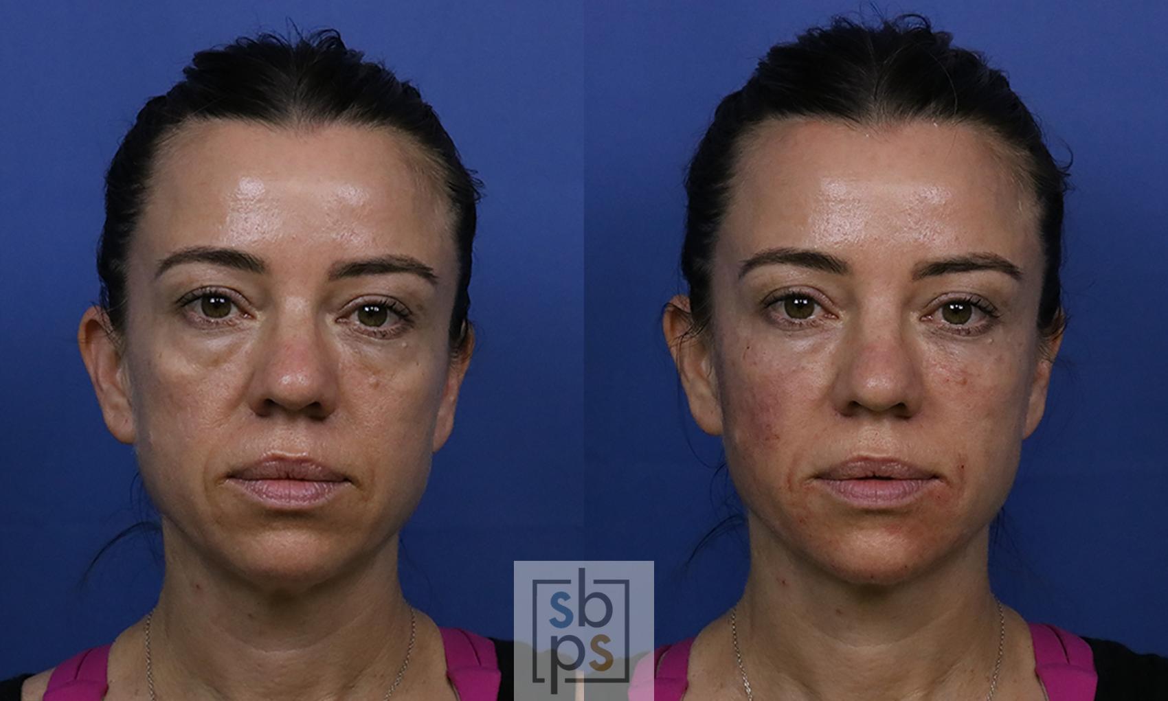 Before & After Dermal Fillers Case 422 Front View in Torrance, CA