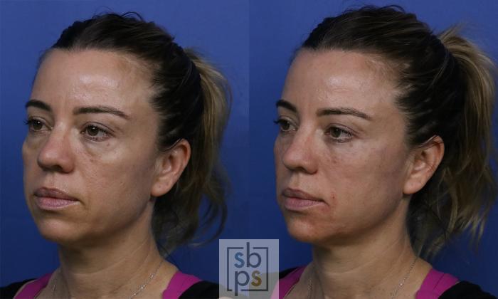 Before & After Dermal Fillers Case 422 Left Oblique View in Torrance, CA