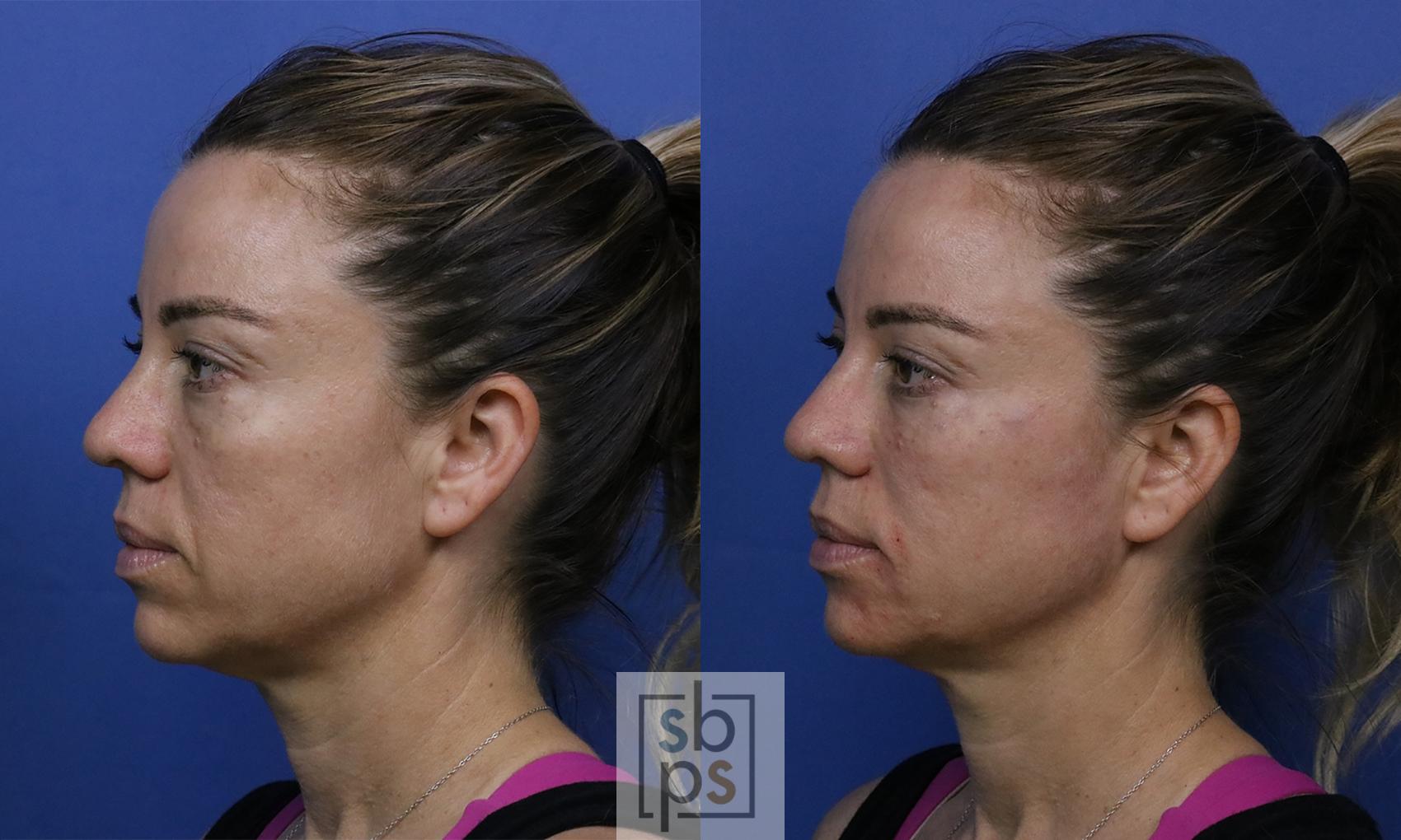 Before & After Dermal Fillers Case 422 Left Side View in Torrance & Los Angeles, CA, CA