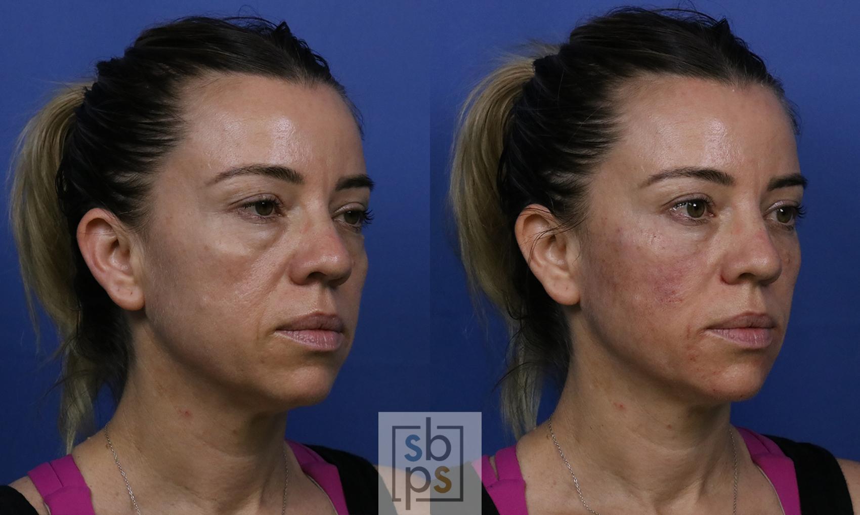 Before & After Dermal Fillers Case 422 Right Oblique View in Torrance & Los Angeles, CA, CA