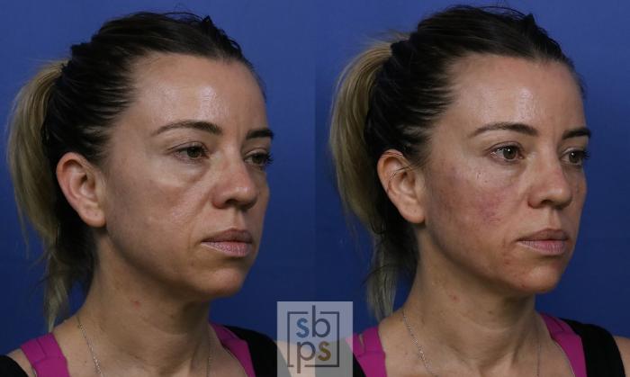 Before & After Dermal Fillers Case 422 Right Oblique View in Torrance, CA