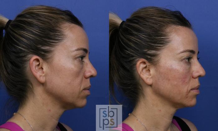 Before & After Dermal Fillers Case 422 Right Side View in Torrance, CA