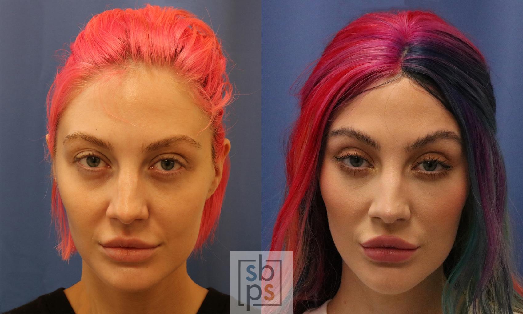 Before & After Dermal Fillers Case 425 Front View in Torrance, CA