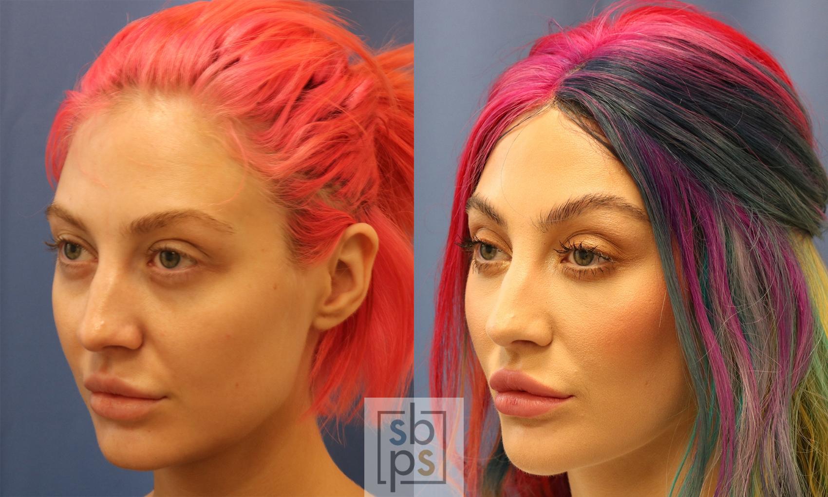 Before & After Dermal Fillers Case 425 Left Oblique View in Torrance & Los Angeles, CA, CA