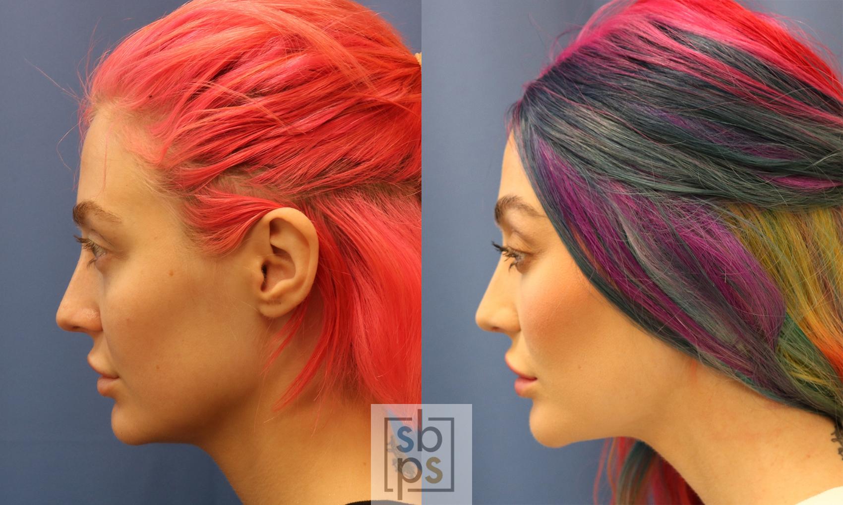 Before & After Dermal Fillers Case 425 Left Side View in Torrance & Los Angeles, CA, CA