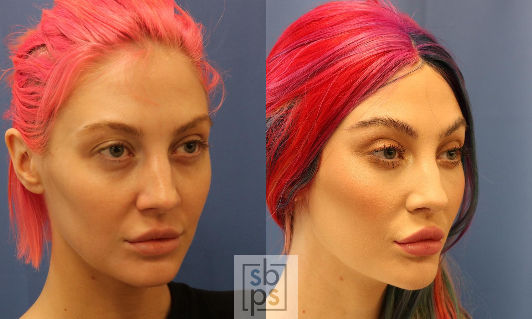 Before & After Dermal Fillers Case 425 Right Oblique View in Torrance & Los Angeles, CA, CA