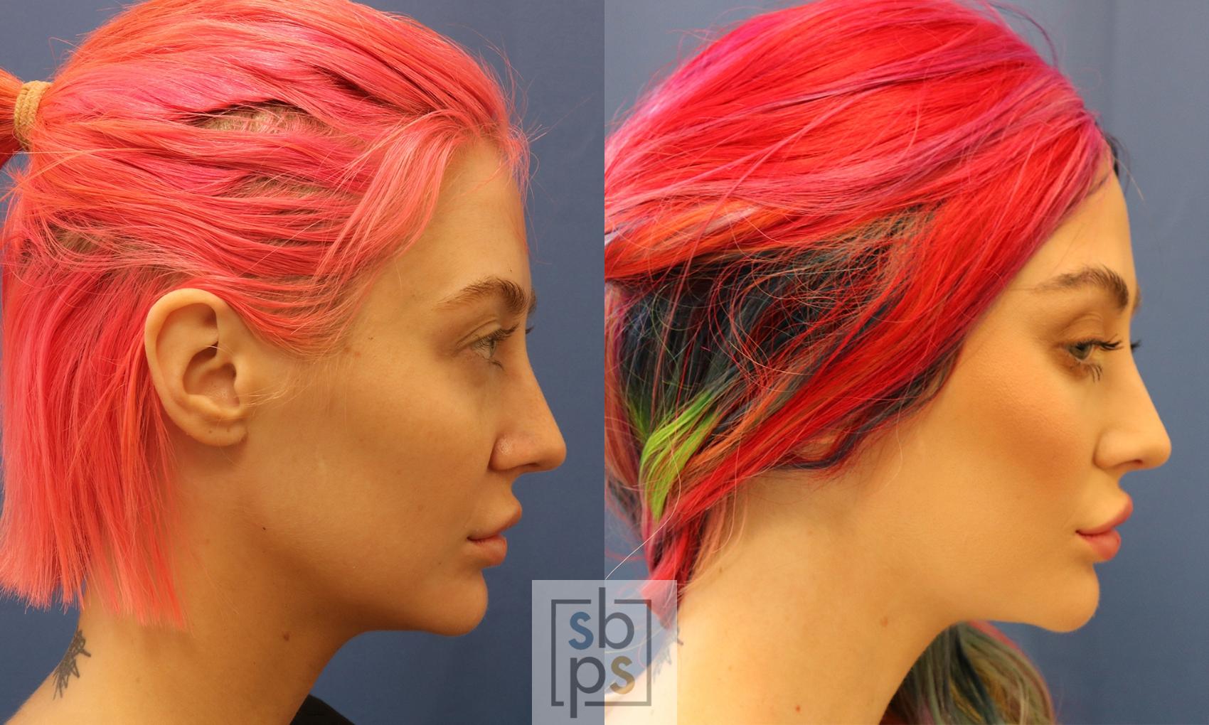 Before & After Dermal Fillers Case 425 Right Side View in Torrance & Los Angeles, CA, CA