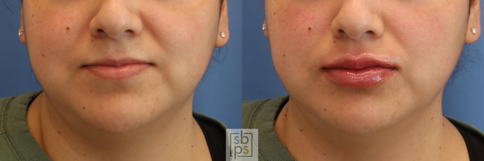 Before & After Dermal Fillers Case 426 Front View in Torrance, CA