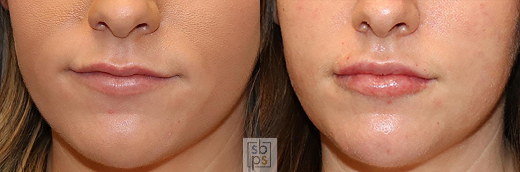 Before & After Dermal Fillers Case 445 Front View in Torrance, CA
