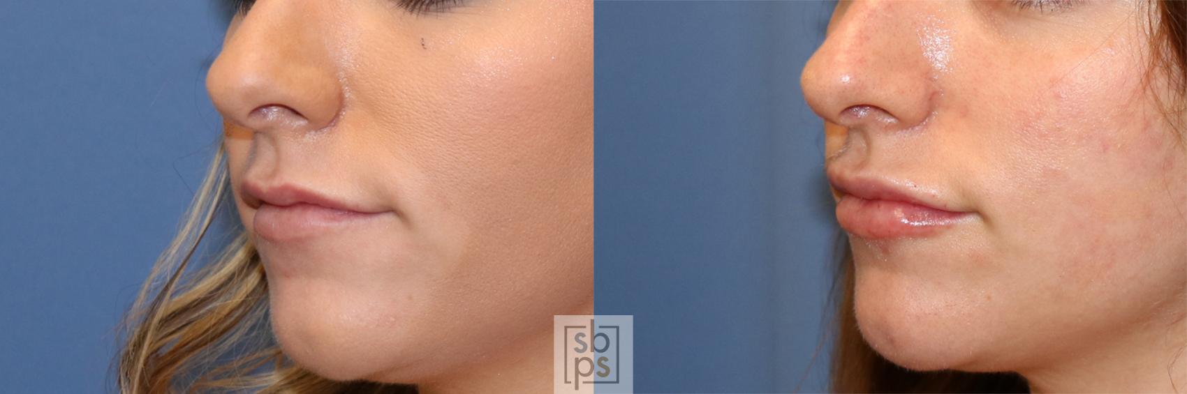 Before & After Dermal Fillers Case 445 Left Oblique View in Torrance & Los Angeles, CA, CA