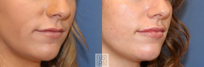 Before & After Dermal Fillers Case 445 Right Oblique View in Torrance, CA