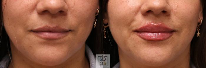 Before & After Dermal Fillers Case 519 Front View in Torrance, CA