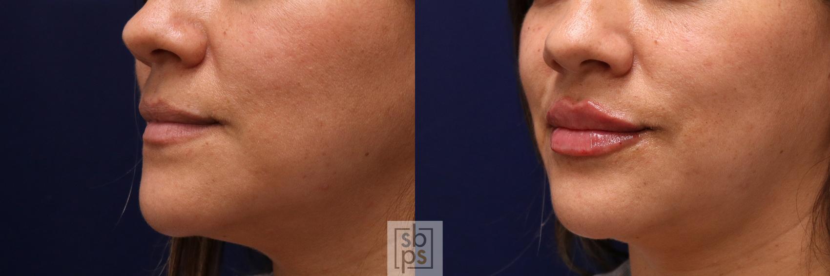 Before & After Dermal Fillers Case 519 Left Oblique View in Torrance & Los Angeles, CA, CA