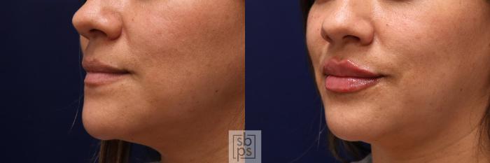 Before & After Dermal Fillers Case 519 Left Oblique View in Torrance, CA