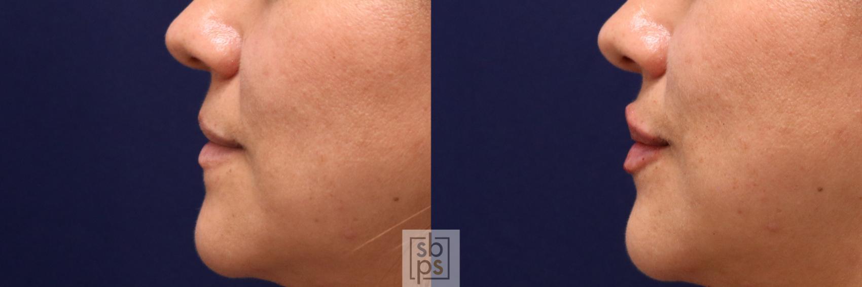 Before & After Dermal Fillers Case 519 Left Side View in Torrance & Los Angeles, CA, CA