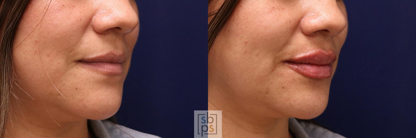 Before & After Dermal Fillers Case 519 Right Oblique View in Torrance & Los Angeles, CA, CA