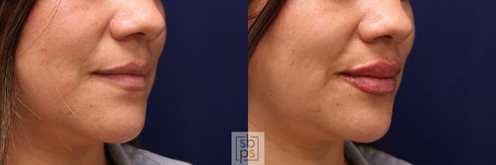 Before & After Dermal Fillers Case 519 Right Oblique View in Torrance, CA