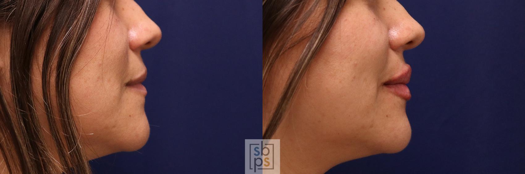 Before & After Dermal Fillers Case 519 Right Side View in Torrance & Los Angeles, CA, CA