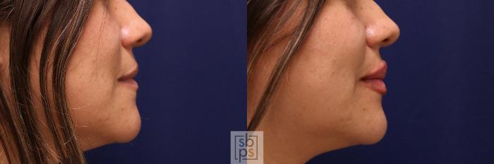 Before & After Dermal Fillers Case 519 Right Side View in Torrance, CA