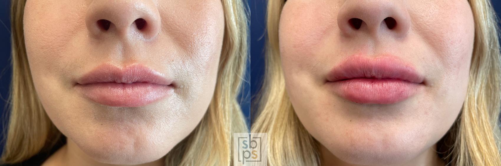 Before & After Dermal Fillers Case 520 Front View in Torrance, CA