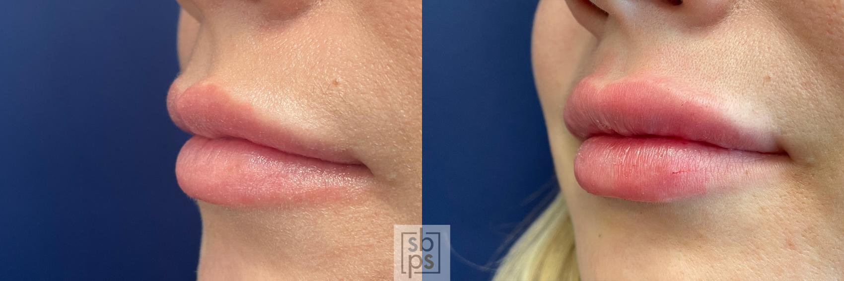Before & After Dermal Fillers Case 520 Left Oblique View in Torrance & Los Angeles, CA, CA