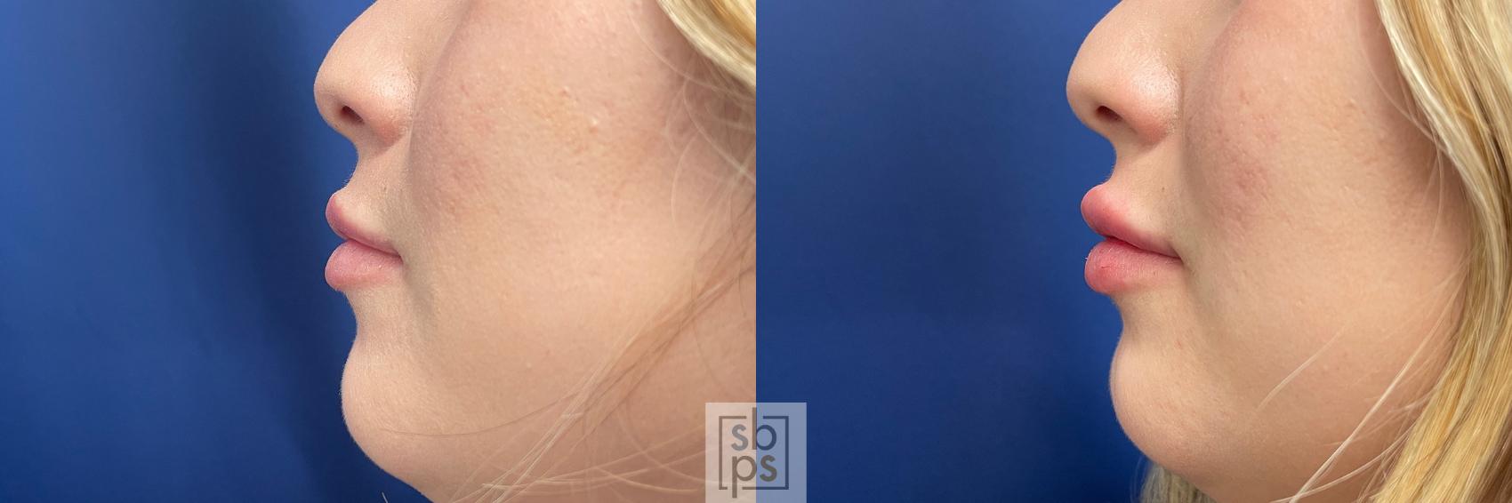 Before & After Dermal Fillers Case 520 Left Side View in Torrance & Los Angeles, CA, CA