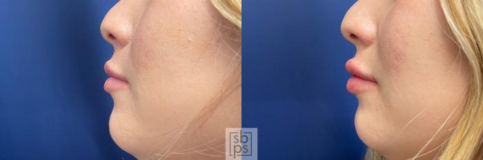 Before & After Dermal Fillers Case 520 Left Side View in Torrance, CA