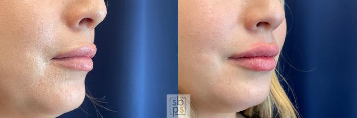 Before & After Dermal Fillers Case 520 Right Oblique View in Torrance, CA