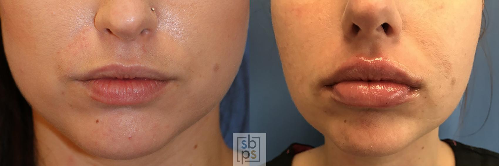 Before & After Dermal Fillers Case 524 Front View in Torrance, CA