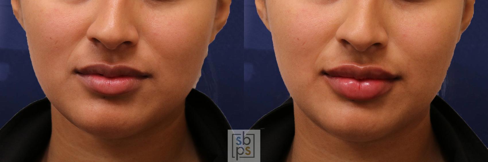 Before & After Dermal Fillers Case 541 Front View in Torrance, CA