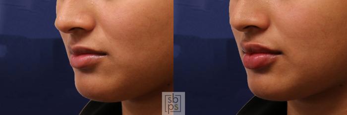 Before & After Dermal Fillers Case 541 Left Oblique View in Torrance, CA