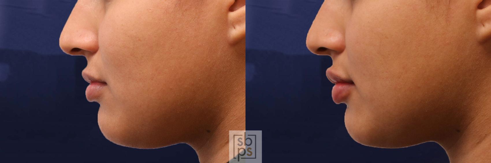 Before & After Dermal Fillers Case 541 Left Side View in Torrance & Los Angeles, CA, CA