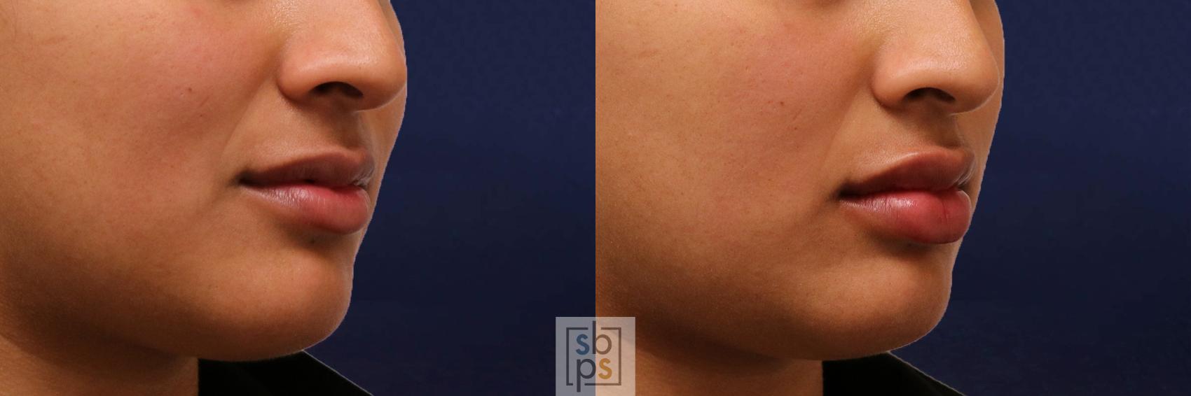 Before & After Dermal Fillers Case 541 Right Oblique View in Torrance & Los Angeles, CA, CA