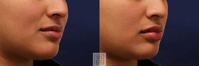 Before & After Dermal Fillers Case 541 Right Oblique View in Torrance, CA
