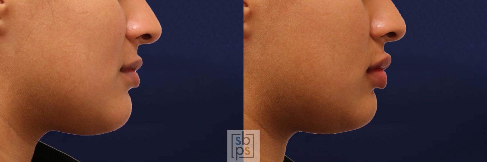 Before & After Dermal Fillers Case 541 Right Side View in Torrance & Los Angeles, CA, CA