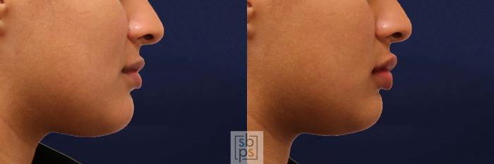 Before & After Dermal Fillers Case 541 Right Side View in Torrance, CA