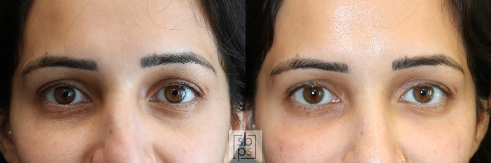 Before & After Dermal Fillers Case 542 Front View in Torrance, CA