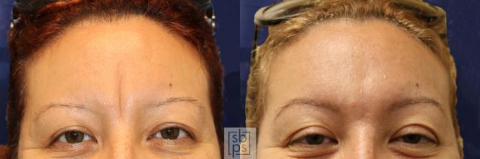 Before & After Dermal Fillers Case 600 Front View in Torrance, CA