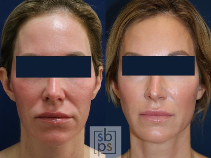 Before & After Dermal Fillers Case 671 Front View in Torrance, CA